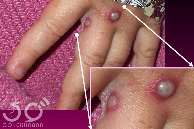 آبله میمونی 